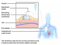 Diagram of a subcutaneous port